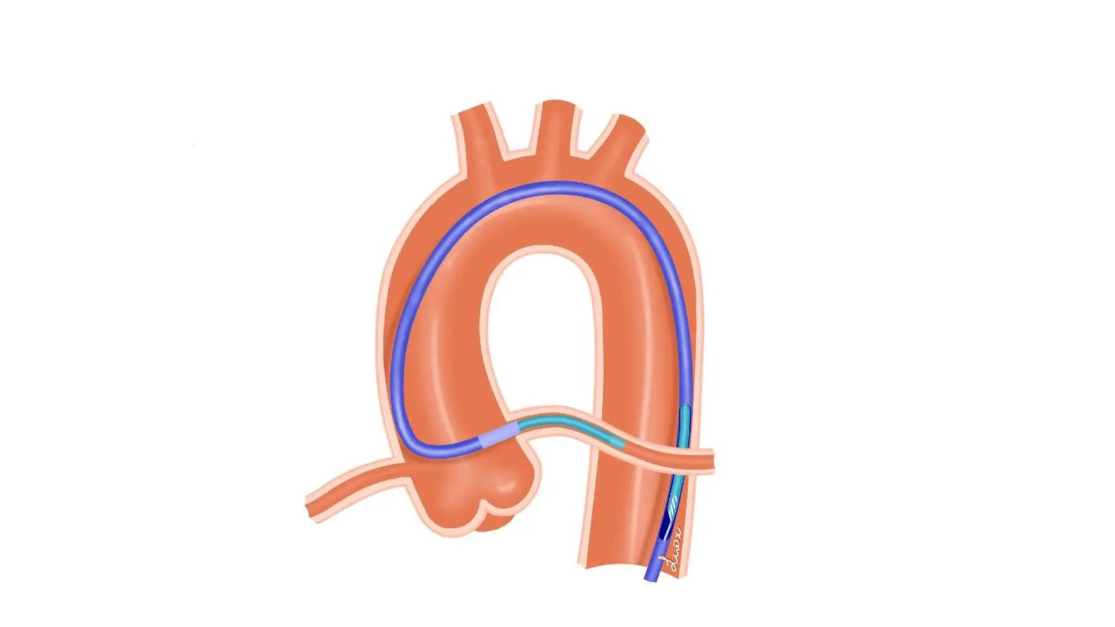医用介入导管的种类以及在线检测设备