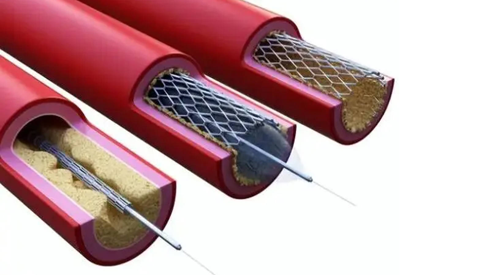 心脏支架/血管支架/带膜支架等合金型聚合物支架的管径测量